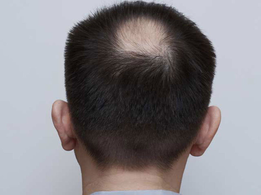 Alopecia areata (pleksgewijze kaalheid) - huidziekten.nl