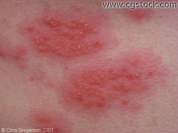 atopic dermatitis pictures #10