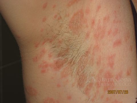 Pityriasis Rosea - American Osteopathic College of ...